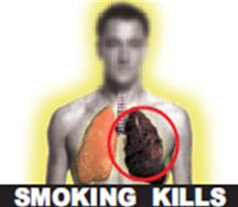 India 2011 Health Effects Lung - Diseased lung 3